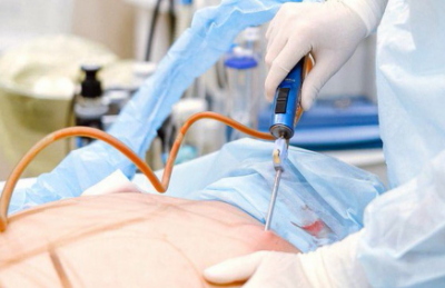 Liposuction